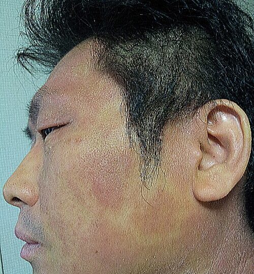アトピーの横顔