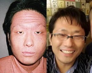 アトピーだった頃と治った後の顔